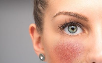 Rosacea