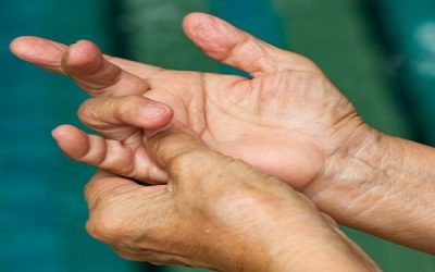 Dupuytren’s Contracture Explained