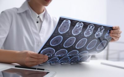 Identifying Early Signs of Multiple Sclerosis