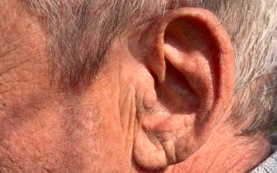 Could Your Earlobes Predict a Heart Attack?