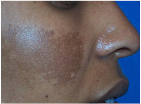 melasma hyperpigmentation example